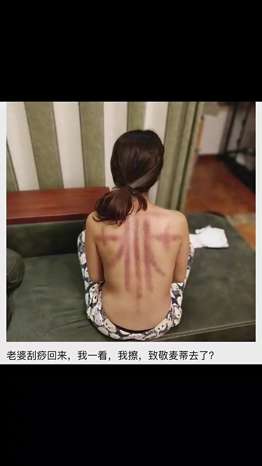 老婆這刮痧是去致敬麥迪嗎還真有點(diǎn)像啊